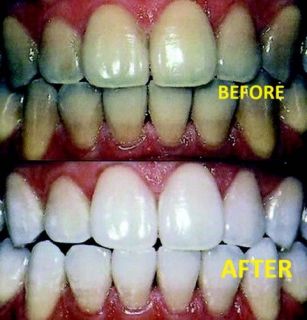   Kit 6 Tooth Bleaching Syringes 22% Dental Trays Quality Gel