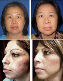 Strongest 0.1) RETINOL A (25g) Anti Wrinkle Aging / Acne Treatment 