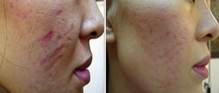 Revitol® Scar Acne Removal Remover Cream Serum Therapy 60ml UK Seller 