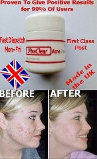Best Acne Blackhead Spot Blemish Treatment Cream (1x 50g Pot